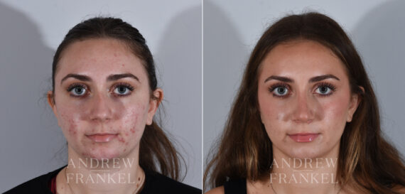 Rhinoplasty before and after photos in Beverly Hills, CA, Patient 24166