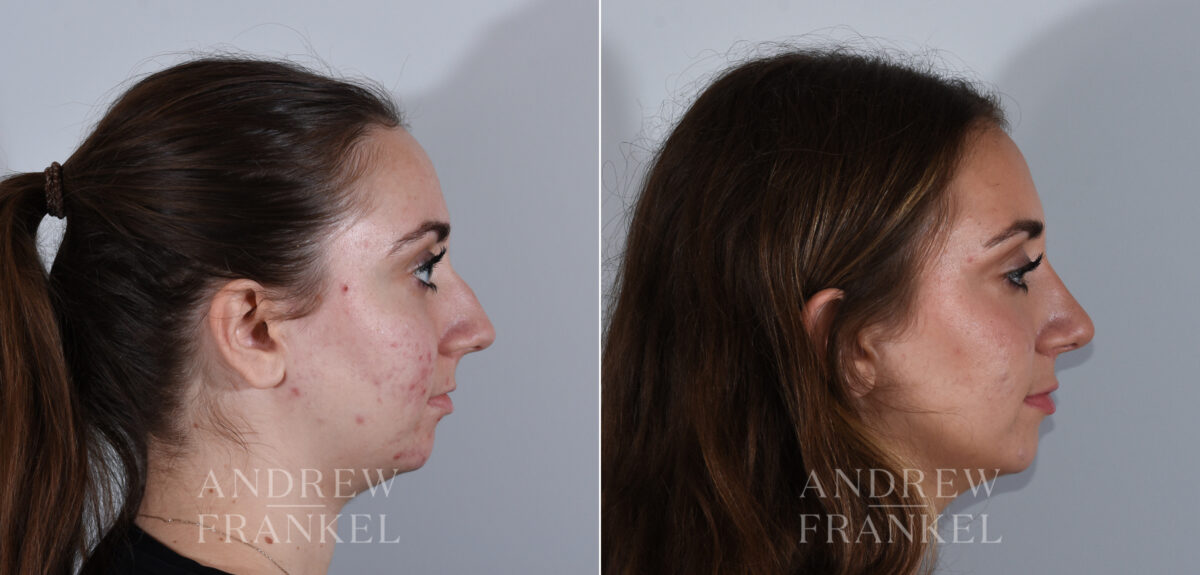 Rhinoplasty before and after photos in Beverly Hills, CA, Patient 24166