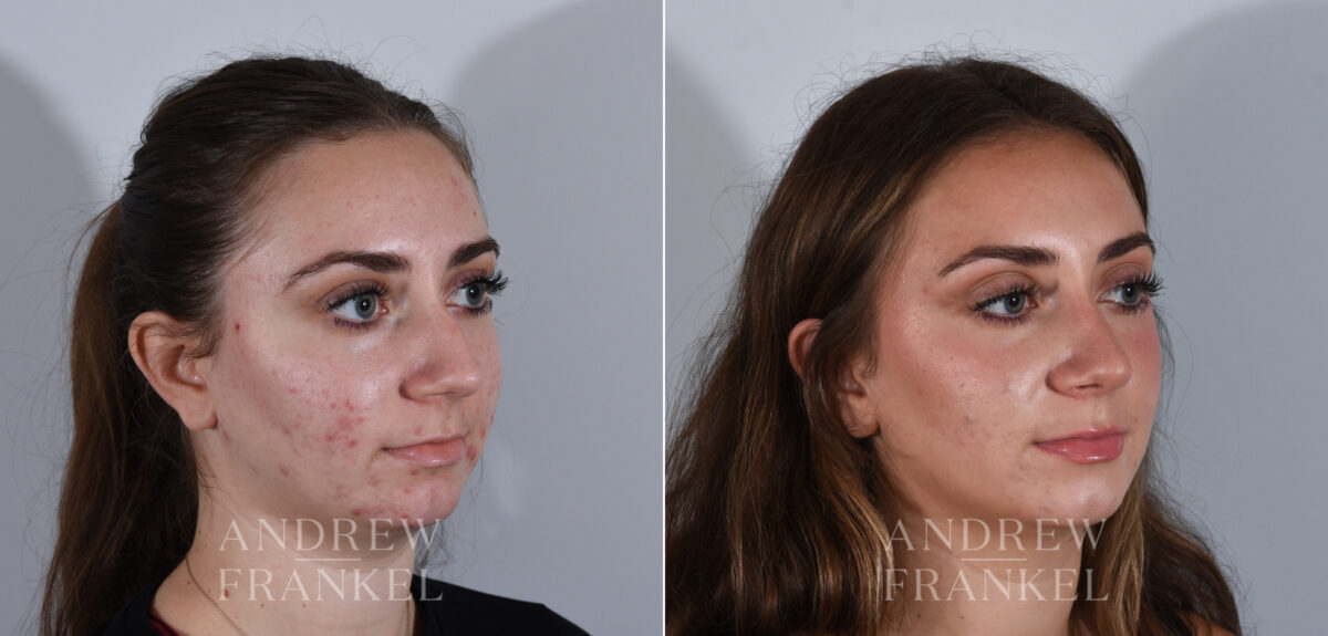 Rhinoplasty before and after photos in Beverly Hills, CA, Patient 24166