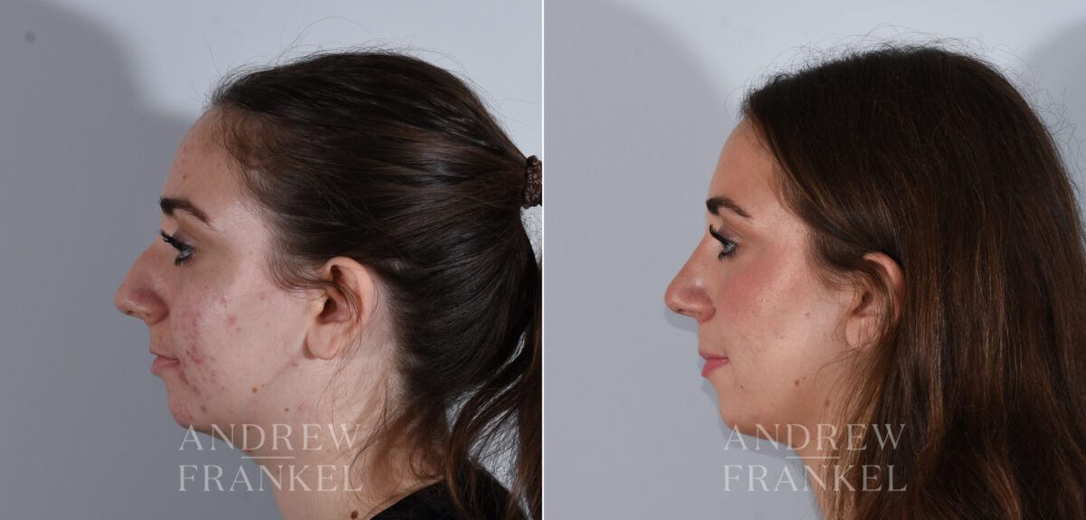 Rhinoplasty before and after photos in Beverly Hills, CA, Patient 24166