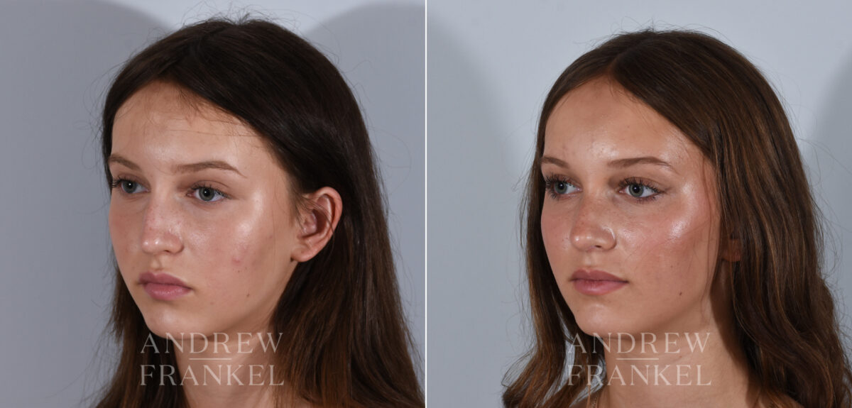 Rhinoplasty before and after photos in Beverly Hills, CA, Patient 24185