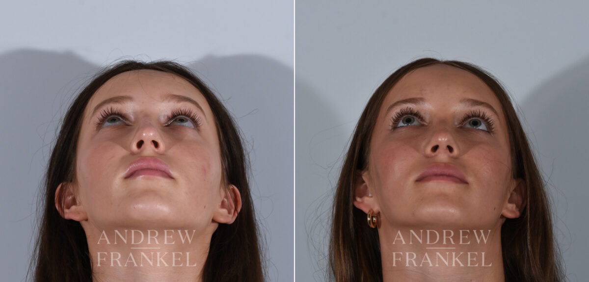 Rhinoplasty before and after photos in Beverly Hills, CA, Patient 24185