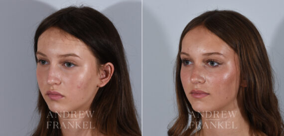 Rhinoplasty before and after photos in Beverly Hills, CA, Patient 24185