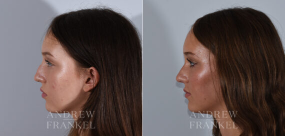 Rhinoplasty before and after photos in Beverly Hills, CA, Patient 24185