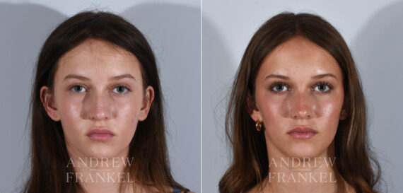 Rhinoplasty before and after photos in Beverly Hills, CA, Patient 24185
