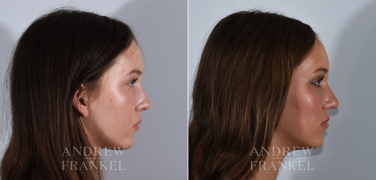 Rhinoplasty before and after photos in Beverly Hills, CA, Patient 24185