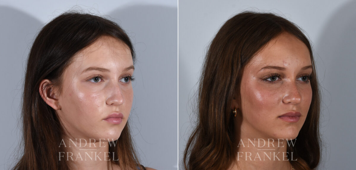 Rhinoplasty before and after photos in Beverly Hills, CA, Patient 24185