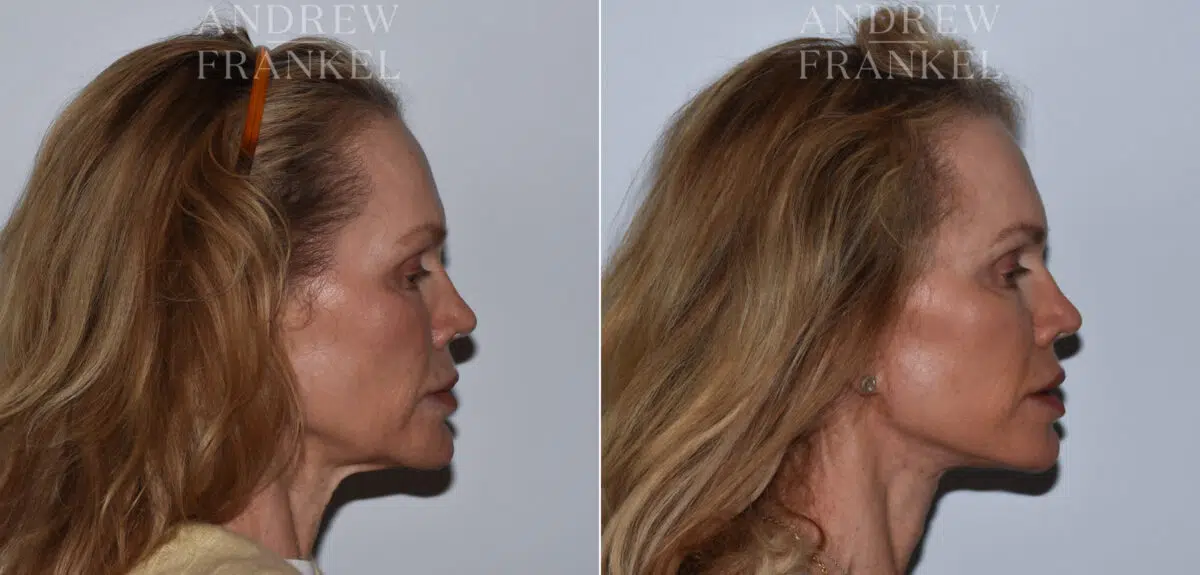 Facelift before and after photos in Beverly Hills, CA, Patient 24217