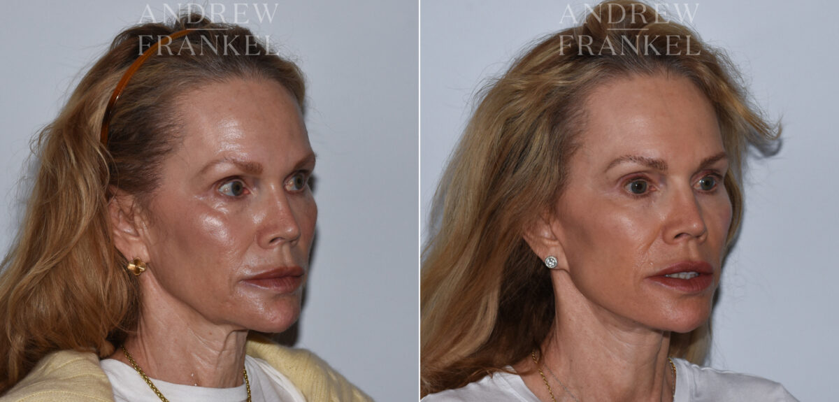 Facelift before and after photos in Beverly Hills, CA, Patient 24217