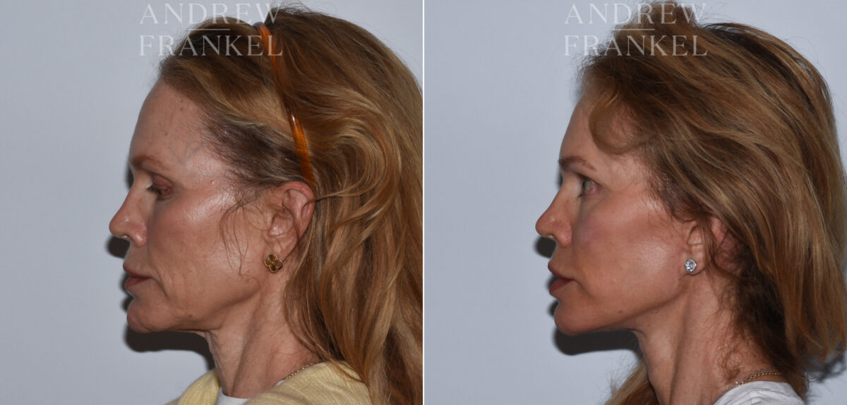 Facelift before and after photos in Beverly Hills, CA, Patient 24217