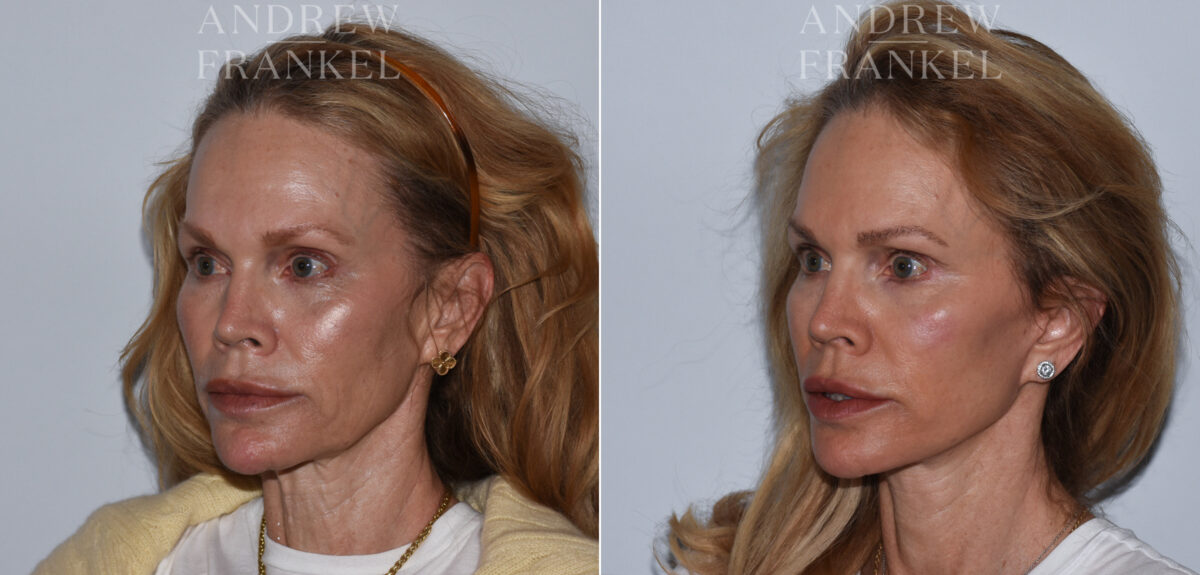Facelift before and after photos in Beverly Hills, CA, Patient 24217