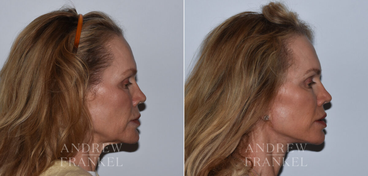 Facelift before and after photos in Beverly Hills, CA, Patient 24217