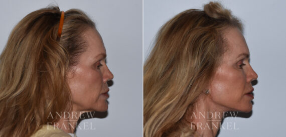 Facelift before and after photos in Beverly Hills, CA, Patient 24217