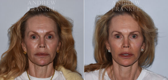 Facelift before and after photos in Beverly Hills, CA, Patient 24217