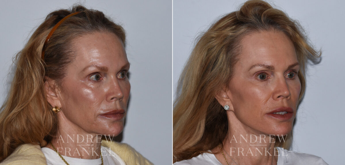 Facelift before and after photos in Beverly Hills, CA, Patient 24217