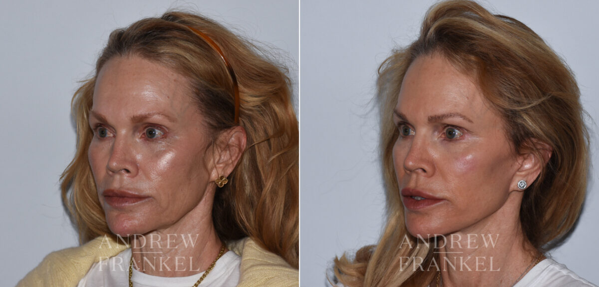 Facelift before and after photos in Beverly Hills, CA, Patient 24217
