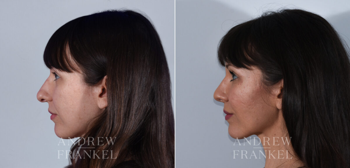 Rhinoplasty before and after photos in Beverly Hills, CA, Patient 24223