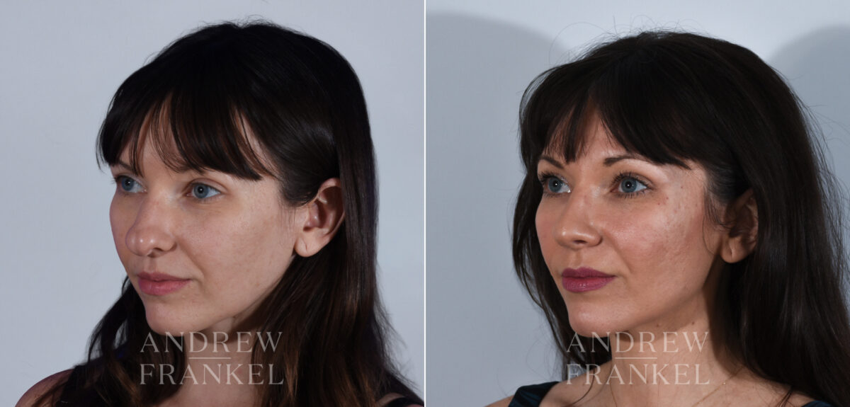 Rhinoplasty before and after photos in Beverly Hills, CA, Patient 24223