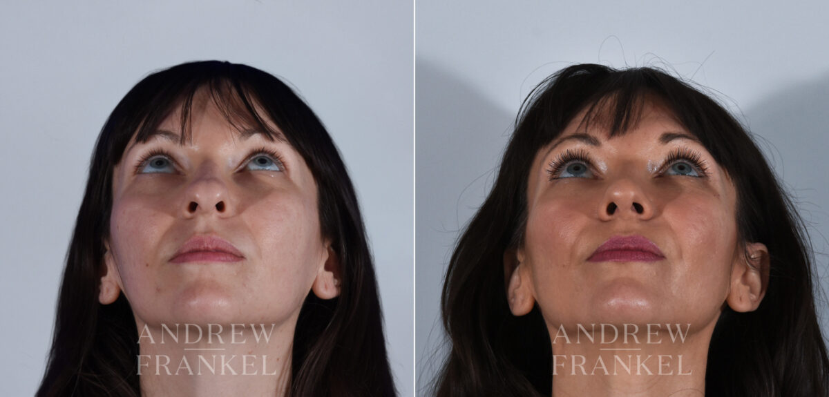 Rhinoplasty before and after photos in Beverly Hills, CA, Patient 24223