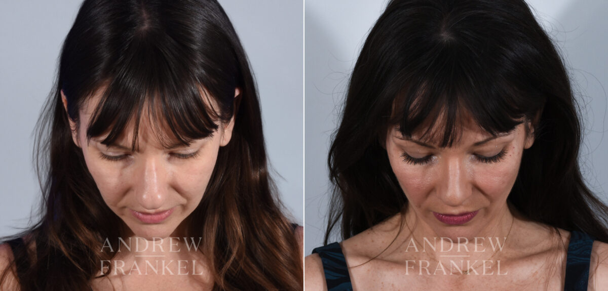 Rhinoplasty before and after photos in Beverly Hills, CA, Patient 24223