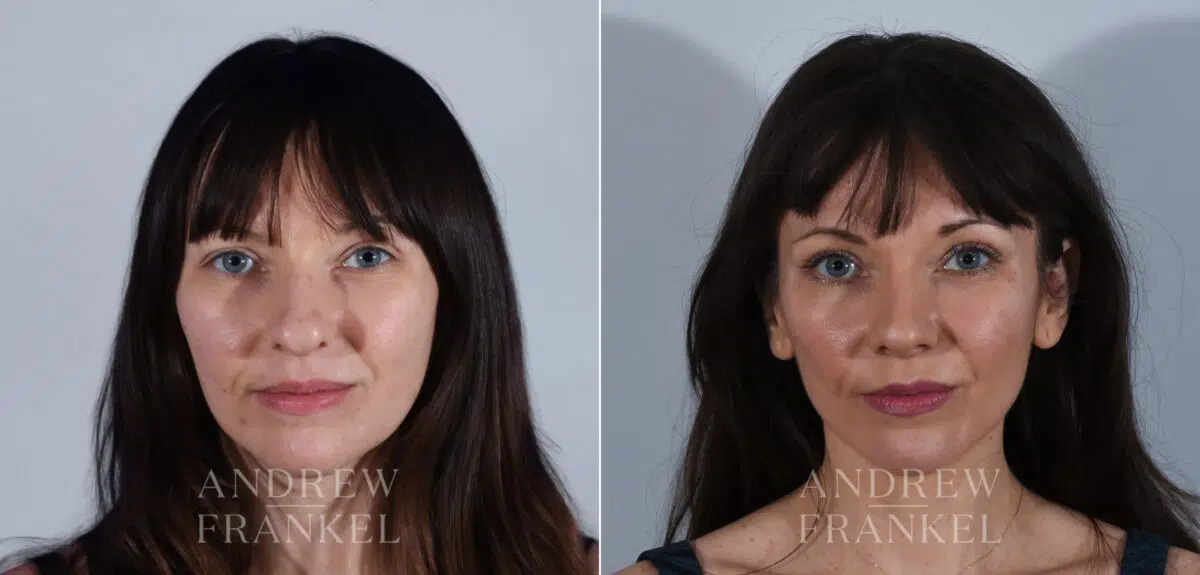 Rhinoplasty before and after photos in Beverly Hills, CA, Patient 24223