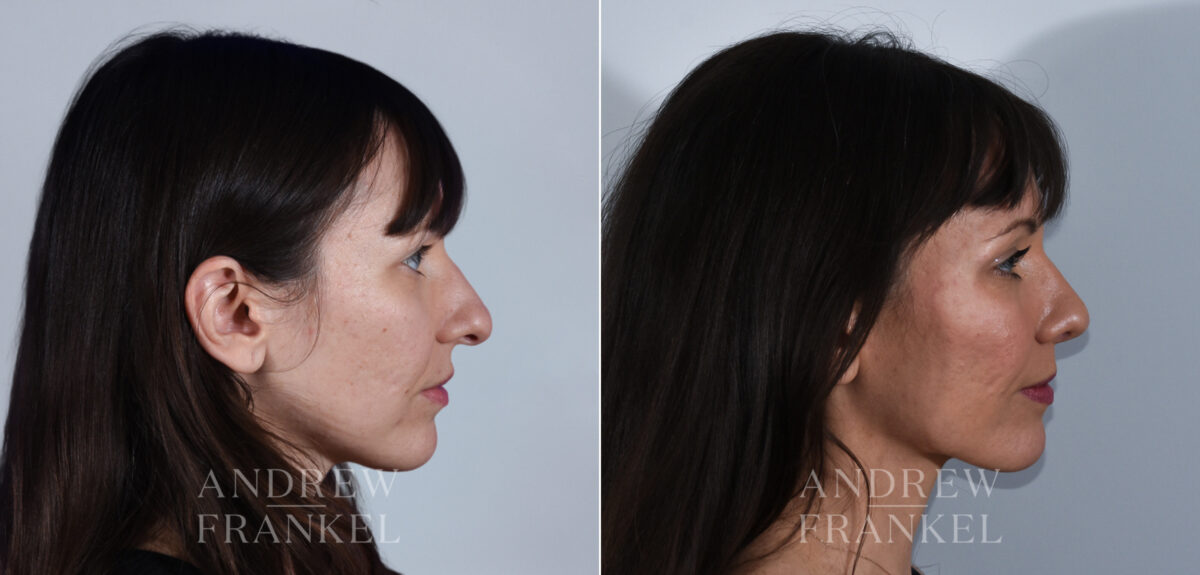 Rhinoplasty before and after photos in Beverly Hills, CA, Patient 24223