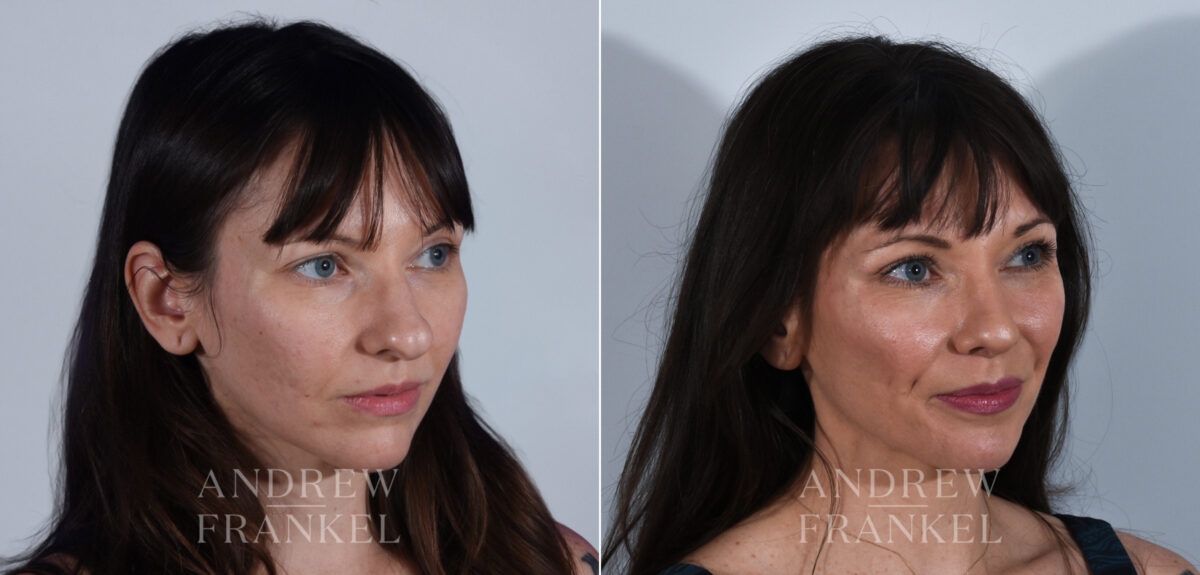 Rhinoplasty before and after photos in Beverly Hills, CA, Patient 24223
