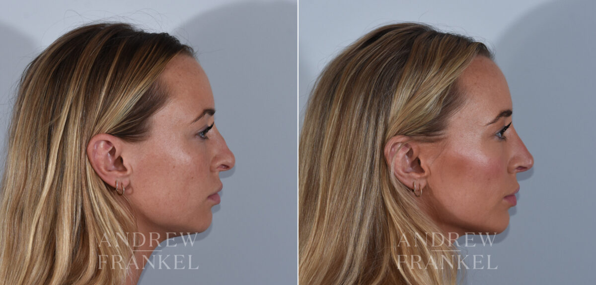Revision Rhinoplasty before and after photos in Beverly Hills, CA, Patient 24294