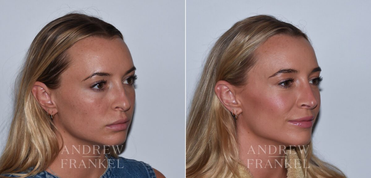 Revision Rhinoplasty before and after photos in Beverly Hills, CA, Patient 24294