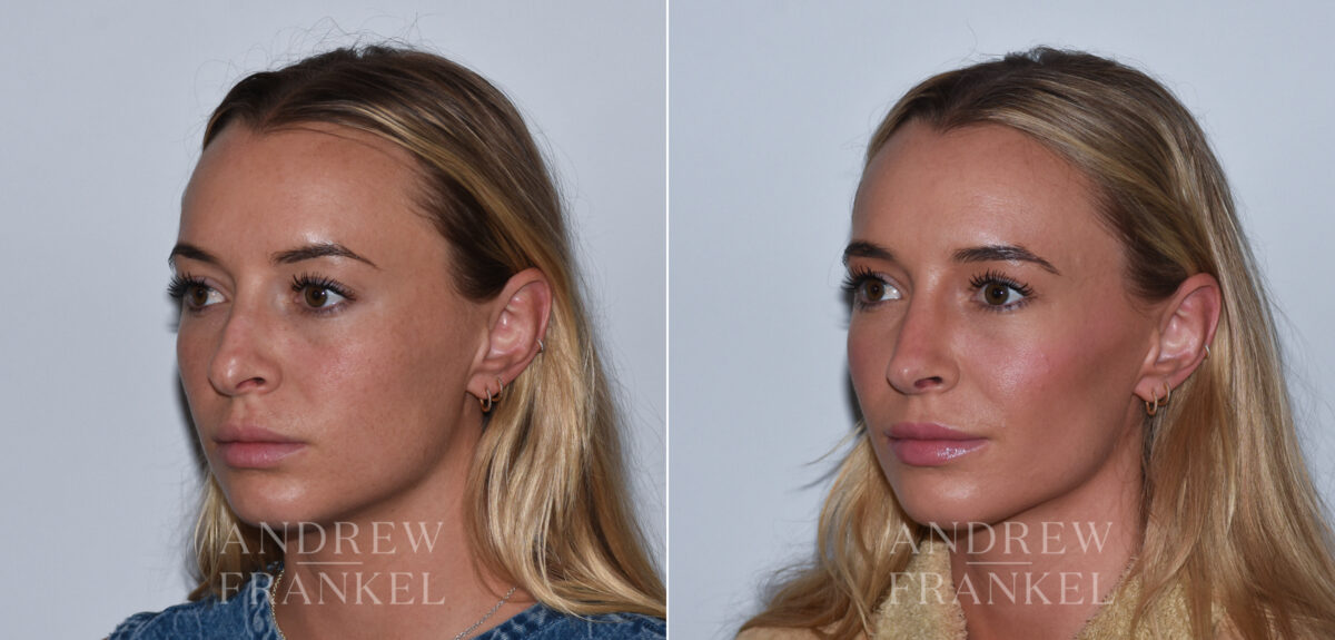 Revision Rhinoplasty before and after photos in Beverly Hills, CA, Patient 24294