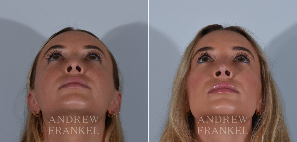 Revision Rhinoplasty before and after photos in Beverly Hills, CA, Patient 24294