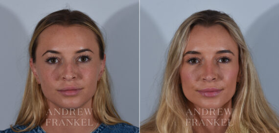 Revision Rhinoplasty before and after photos in Beverly Hills, CA, Patient 24294